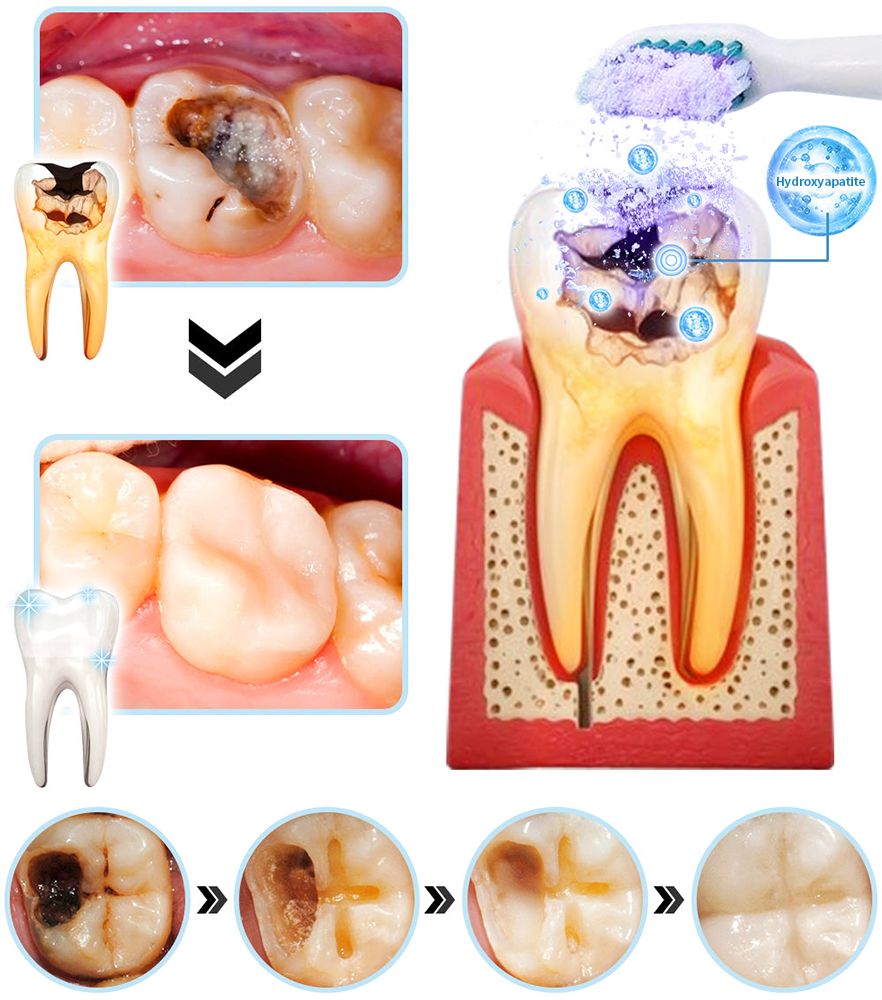 🎁Flash Sale - Don’t Miss Out - DOCTIA® Teeth Restoration Mineral Powder🦷(ADA recommended)👩‍⚕️(Treats periodontitis and mouth ulcers, prevents tooth loss, and repairs gum recession)